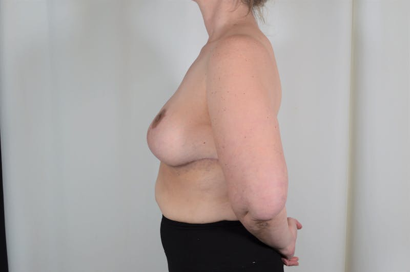 Breast Reduction Before & After Gallery - Patient 126050 - Image 8