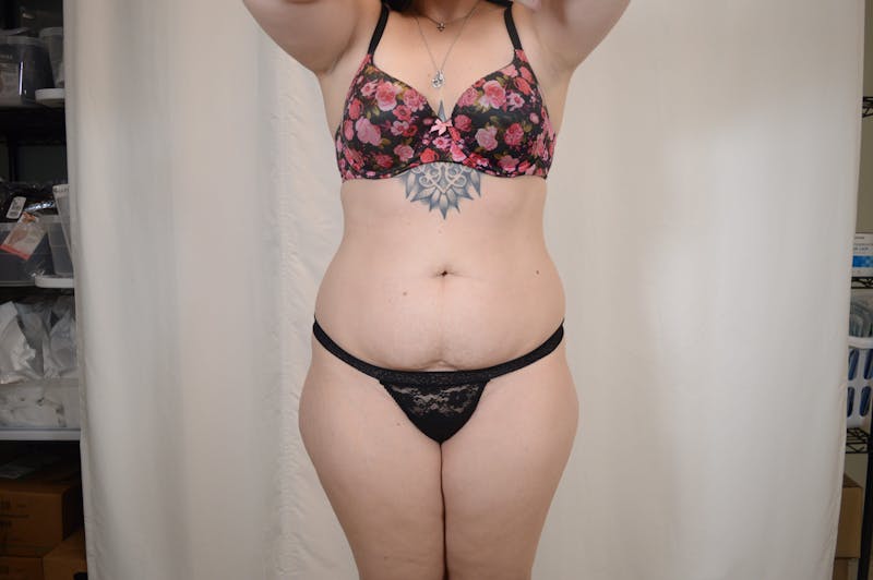Tummy Tuck Before & After Gallery - Patient 306045 - Image 1