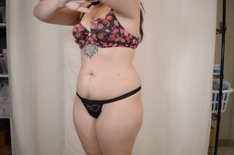 Tummy Tuck Before & After Gallery - Patient 306045 - Image 3