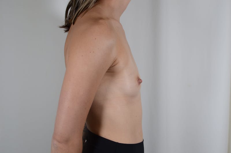 Breast Augmentation Before & After Gallery - Patient 155375 - Image 9