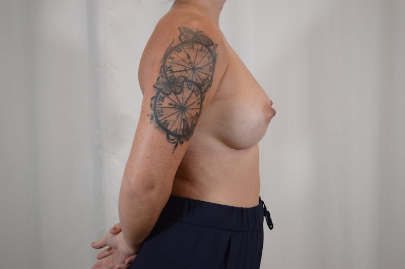 Breast Augmentation Before & After Gallery - Patient 374423 - Image 6