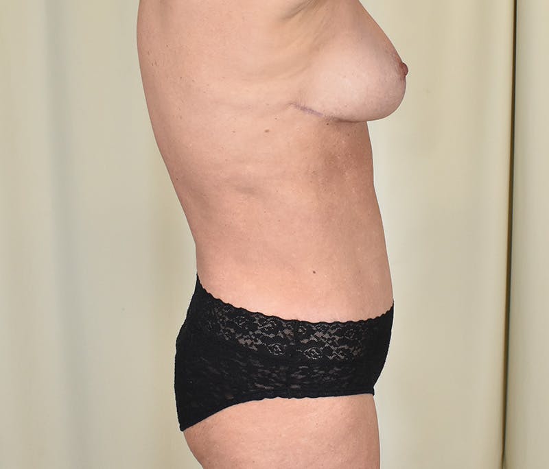 Tummy Tuck Before & After Gallery - Patient 134863 - Image 4
