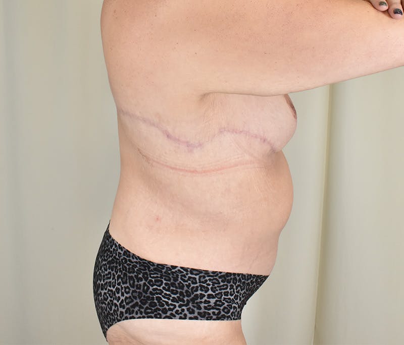 Tummy Tuck Before & After Gallery - Patient 198441 - Image 4