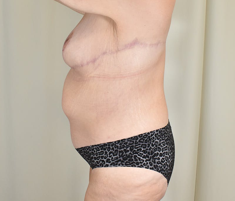 Tummy Tuck Before & After Gallery - Patient 198441 - Image 6
