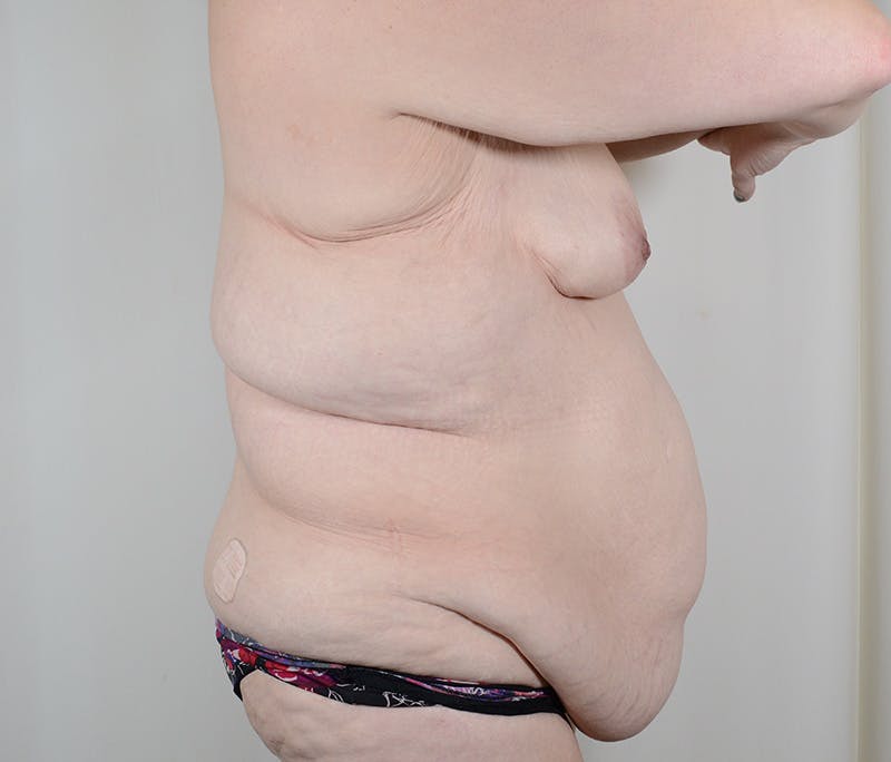 Tummy Tuck Before & After Gallery - Patient 198441 - Image 3
