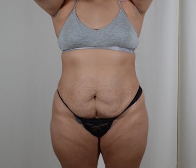 Tummy Tuck Before & After Gallery - Patient 131761 - Image 1