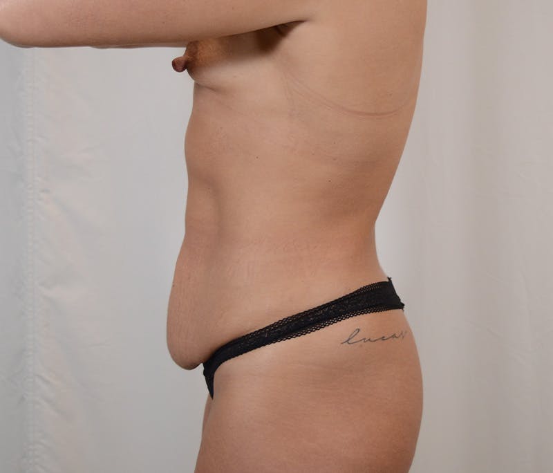 Tummy Tuck Before & After Gallery - Patient 185017 - Image 9