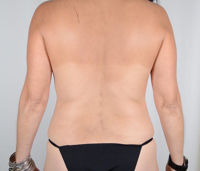 Tummy Tuck Before & After Gallery - Patient 298795 - Image 8