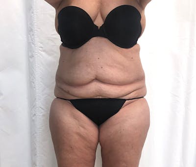 Tummy Tuck Before & After Gallery - Patient 327699 - Image 1