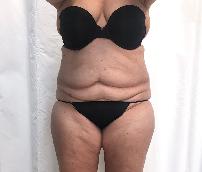 Tummy Tuck Before & After Gallery - Patient 327699 - Image 1