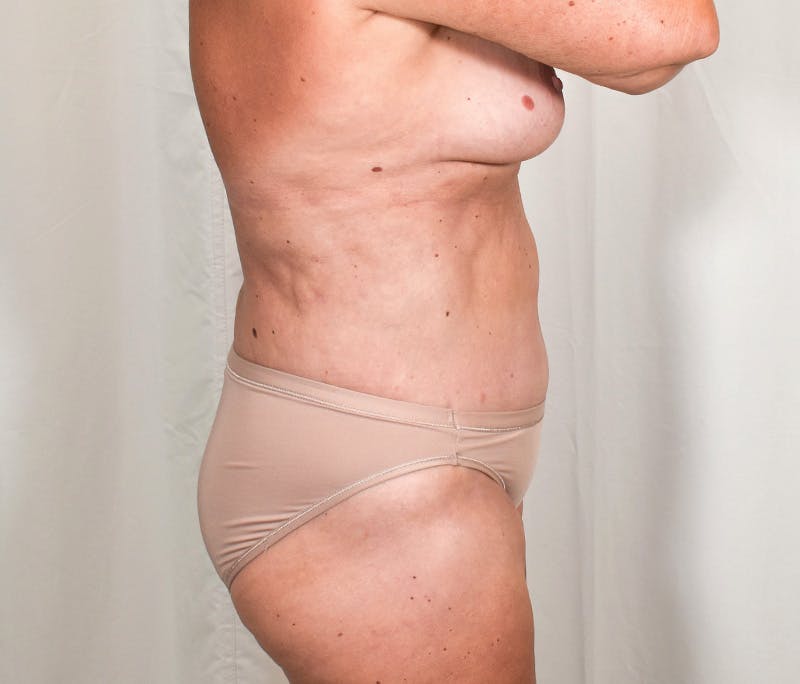 Tummy Tuck Before & After Gallery - Patient 327699 - Image 4