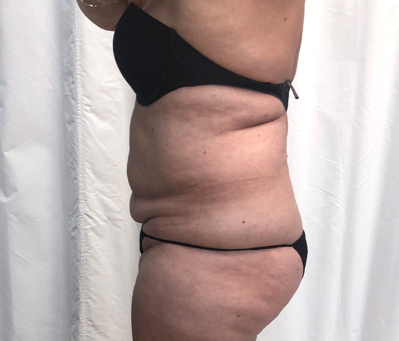 Tummy Tuck Before & After Gallery - Patient 327699 - Image 5
