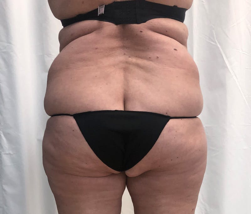 Tummy Tuck Before & After Gallery - Patient 327699 - Image 7