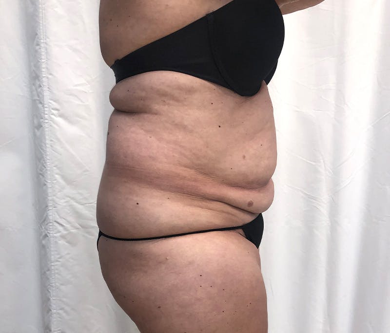 Tummy Tuck Before & After Gallery - Patient 327699 - Image 3