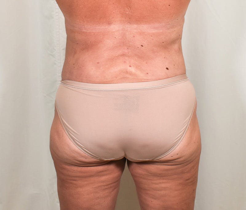 Tummy Tuck Before & After Gallery - Patient 327699 - Image 8