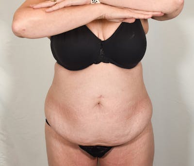 Tummy Tuck Before & After Gallery - Patient 424397 - Image 1