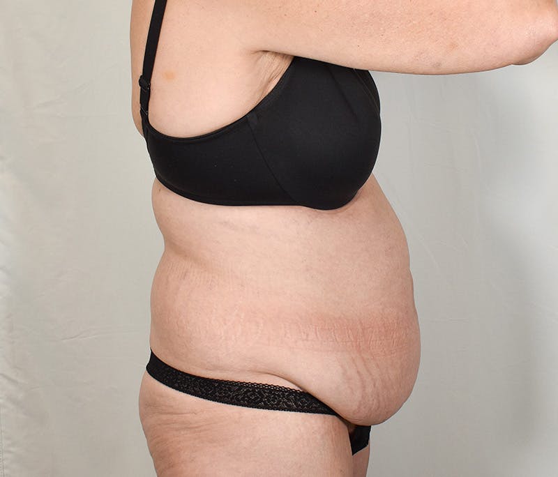 Tummy Tuck Before & After Gallery - Patient 424397 - Image 3