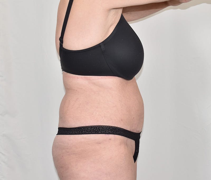 Tummy Tuck Before & After Gallery - Patient 424397 - Image 4