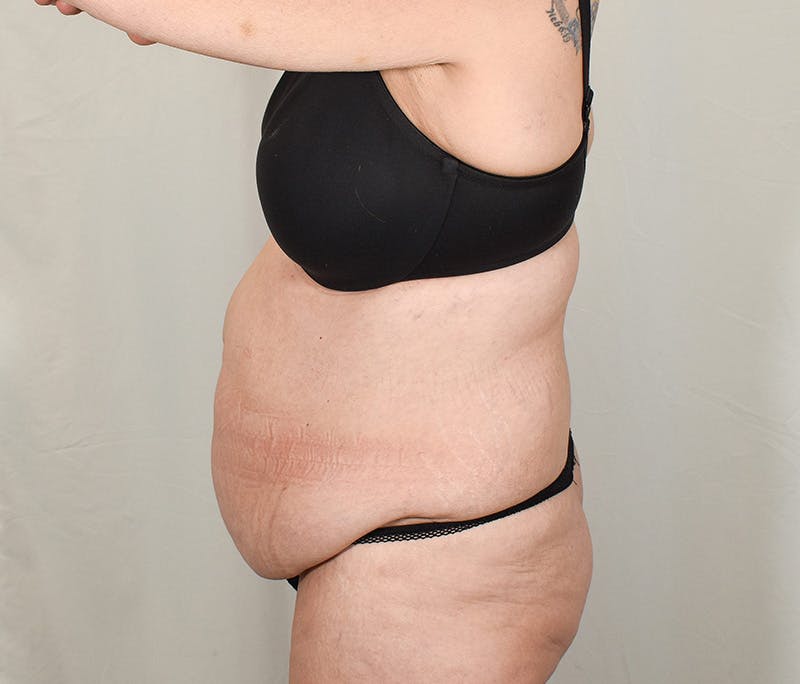 Tummy Tuck Before & After Gallery - Patient 424397 - Image 5