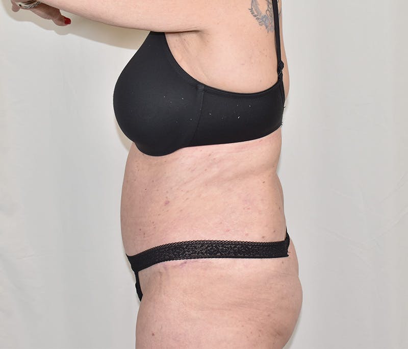 Tummy Tuck Before & After Gallery - Patient 424397 - Image 6