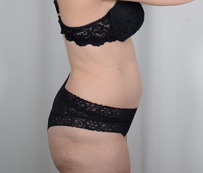 Tummy Tuck Before & After Gallery - Patient 893535 - Image 3