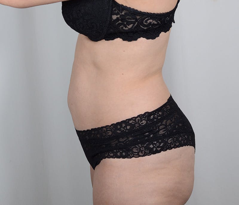 Tummy Tuck Before & After Gallery - Patient 893535 - Image 5