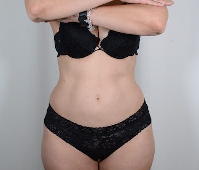 Tummy Tuck Before & After Gallery - Patient 893535 - Image 1