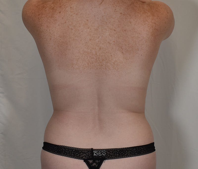 Tummy Tuck Before & After Gallery - Patient 289999 - Image 7