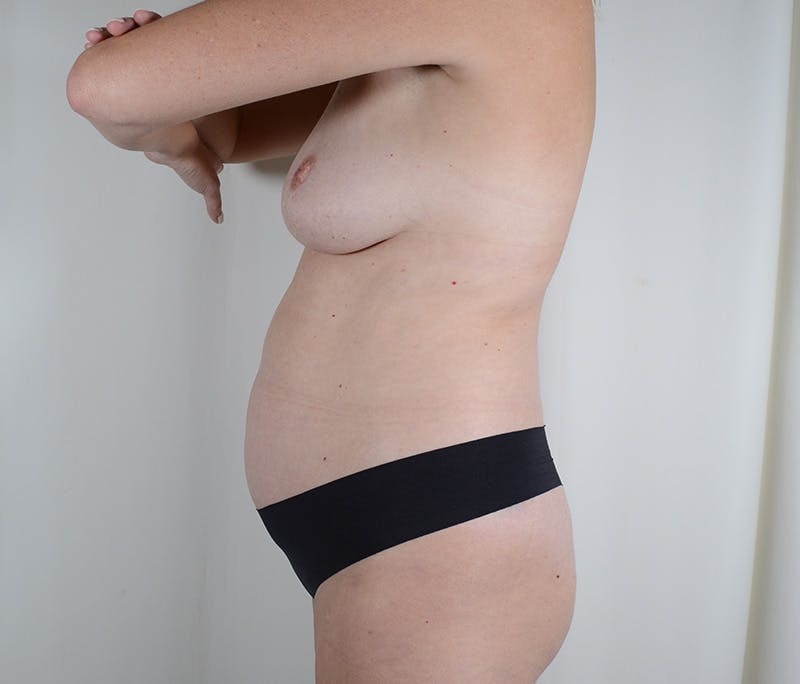 Tummy Tuck Before & After Gallery - Patient 377714 - Image 5