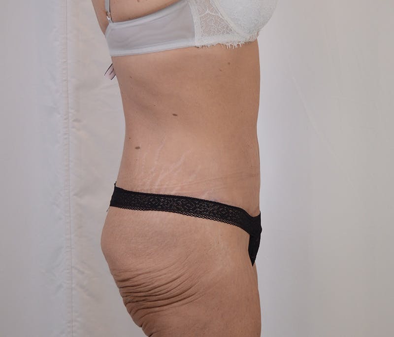 Tummy Tuck Before & After Gallery - Patient 101429 - Image 6