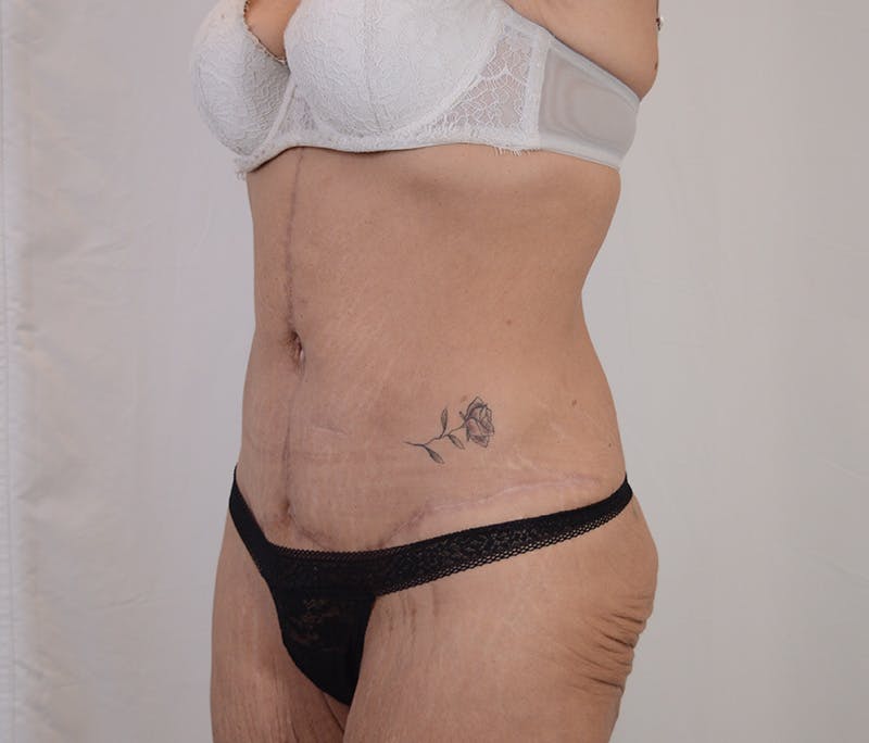 Tummy Tuck Before & After Gallery - Patient 101429 - Image 8