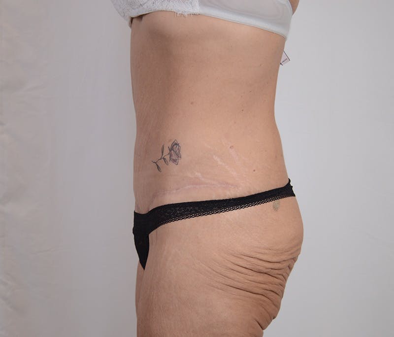 Tummy Tuck Before & After Gallery - Patient 101429 - Image 10