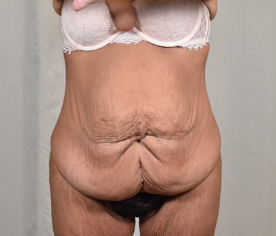 Tummy Tuck Before & After Gallery - Patient 101429 - Image 1