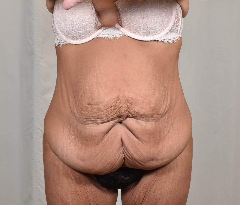 Tummy Tuck Before & After Gallery - Patient 101429 - Image 1