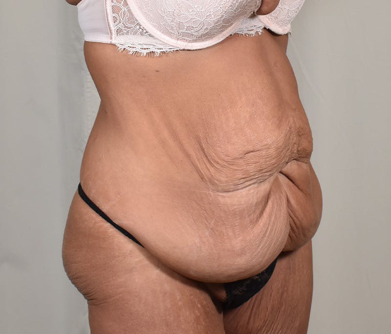 Tummy Tuck Before & After Gallery - Patient 101429 - Image 3