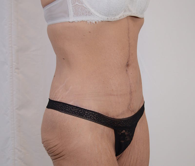 Tummy Tuck Before & After Gallery - Patient 101429 - Image 4