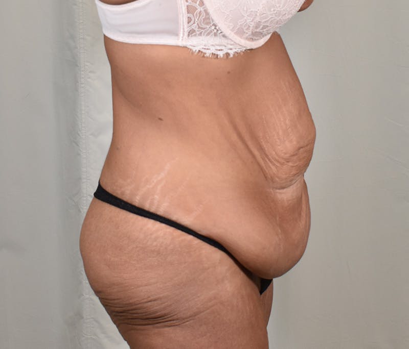 Tummy Tuck Before & After Gallery - Patient 101429 - Image 5