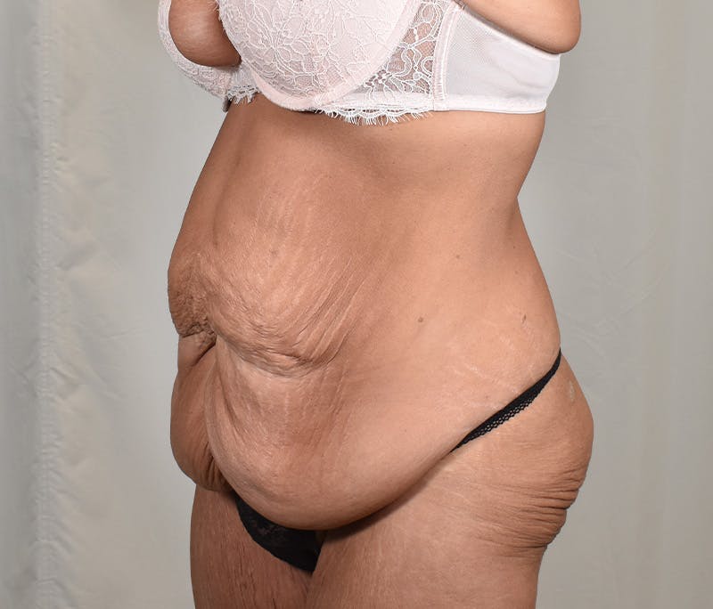 Tummy Tuck Before & After Gallery - Patient 101429 - Image 7