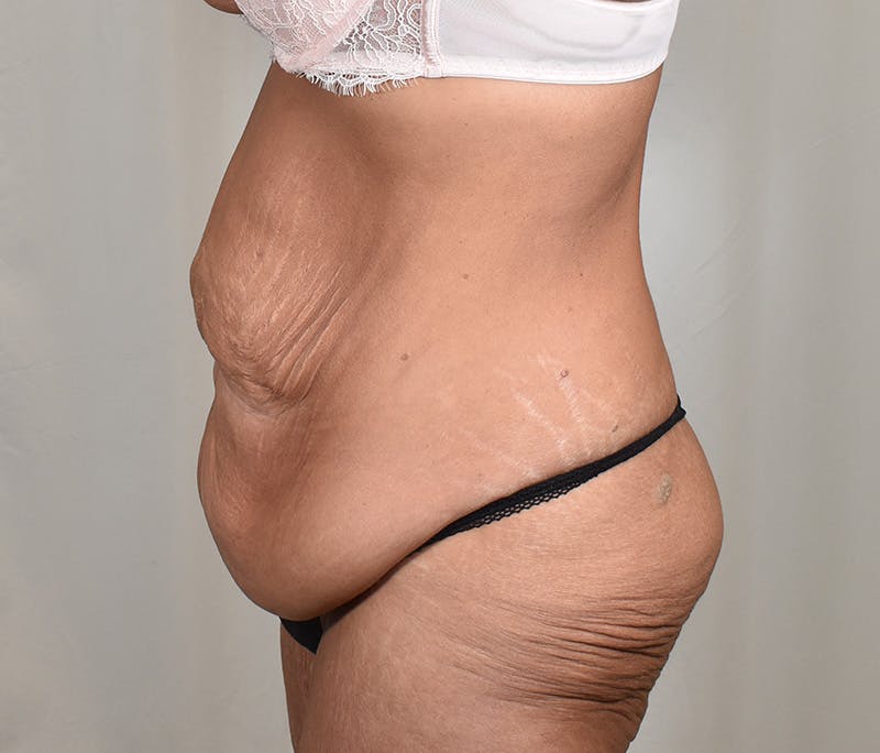 Tummy Tuck Before & After Gallery - Patient 101429 - Image 9