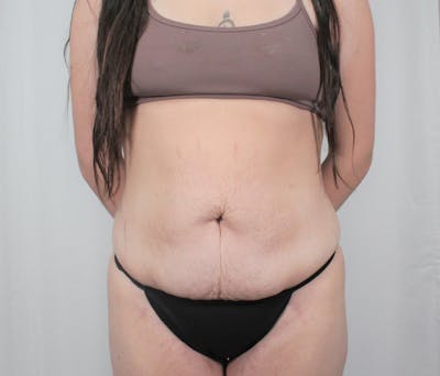 Tummy Tuck Before & After Gallery - Patient 242761 - Image 1