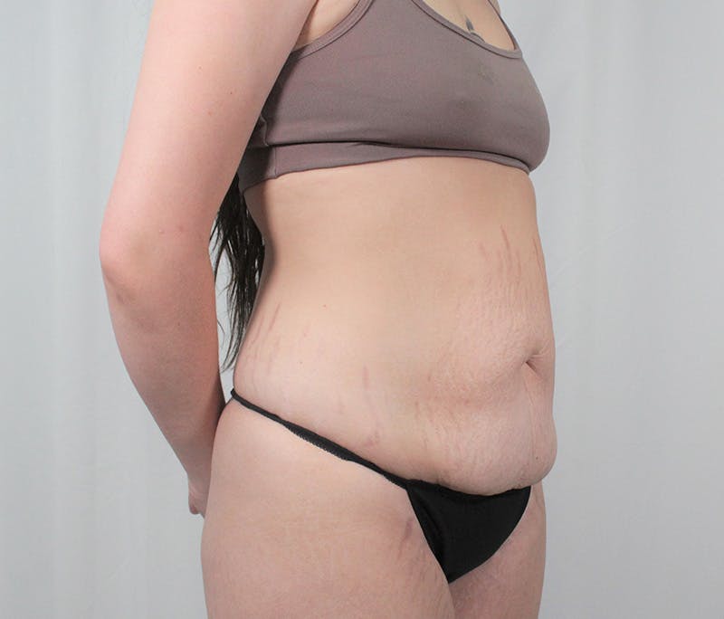 Tummy Tuck Before & After Gallery - Patient 242761 - Image 3