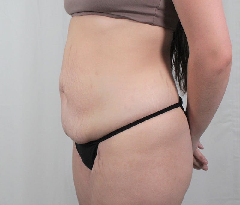 Tummy Tuck Before & After Gallery - Patient 242761 - Image 7