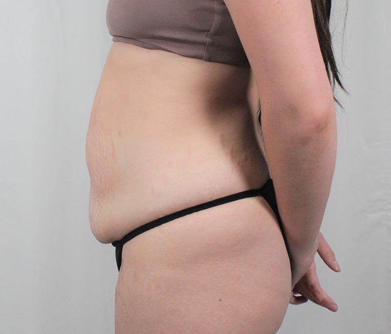 Tummy Tuck Before & After Gallery - Patient 242761 - Image 9