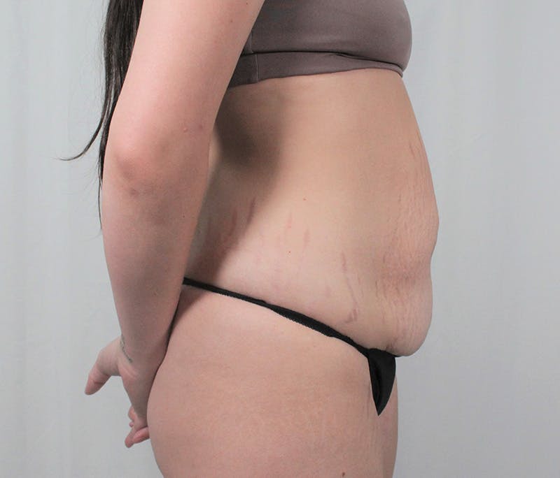Tummy Tuck Before & After Gallery - Patient 242761 - Image 5