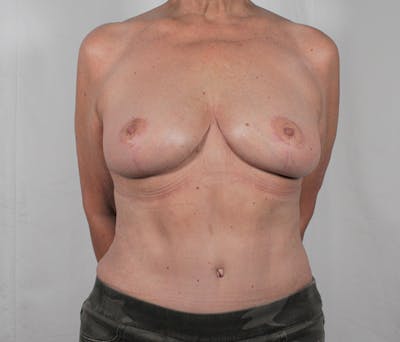 Tummy Tuck Before & After Gallery - Patient 177614 - Image 2