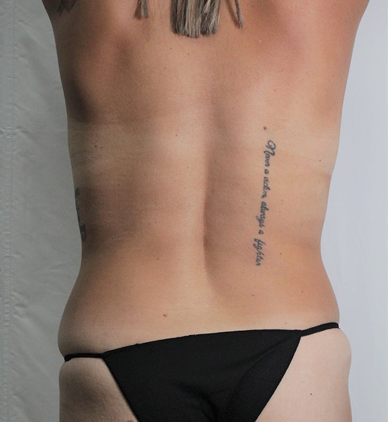 Tummy Tuck Before & After Gallery - Patient 389177 - Image 7