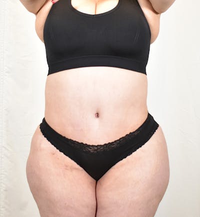 Tummy Tuck Before & After Gallery - Patient 293804 - Image 2