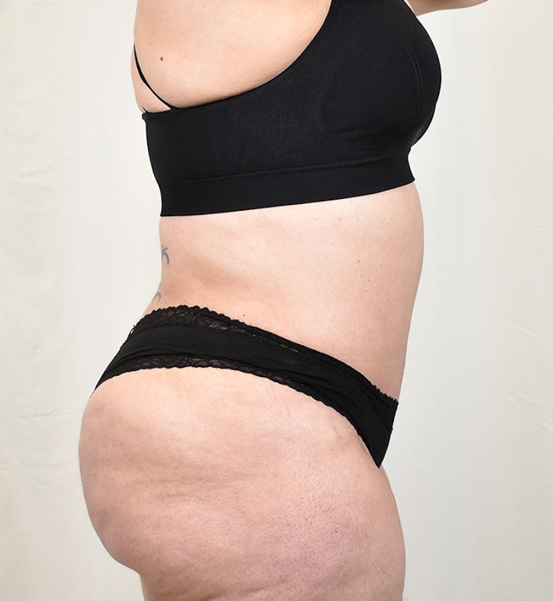 Tummy Tuck Before & After Gallery - Patient 293804 - Image 6