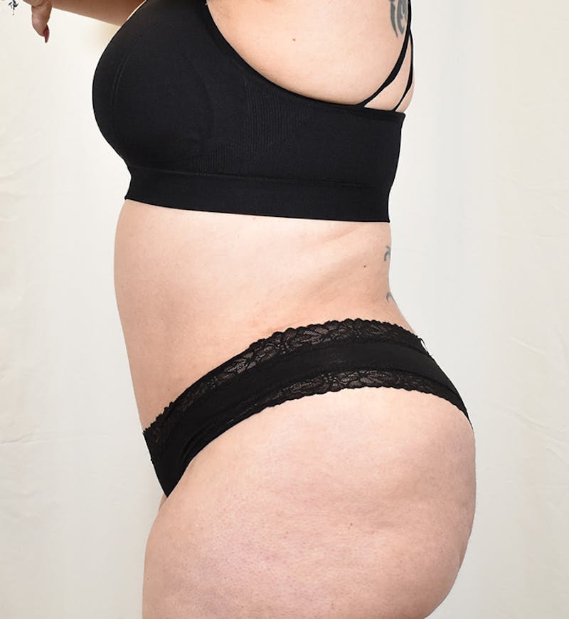 Tummy Tuck Before & After Gallery - Patient 293804 - Image 8