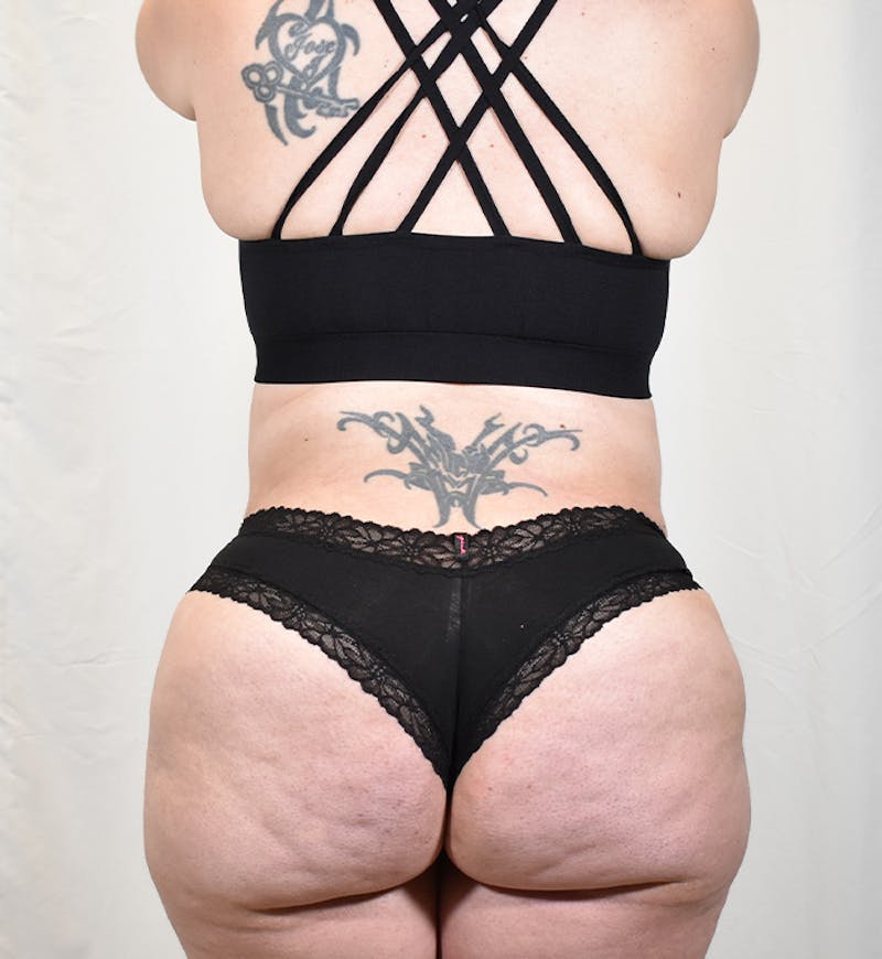 Tummy Tuck Before & After Gallery - Patient 293804 - Image 10